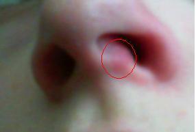 Rotung Im Nasenloch Beauty Nase Hno Rotung Im Nasenloch Beauty Nase Hno