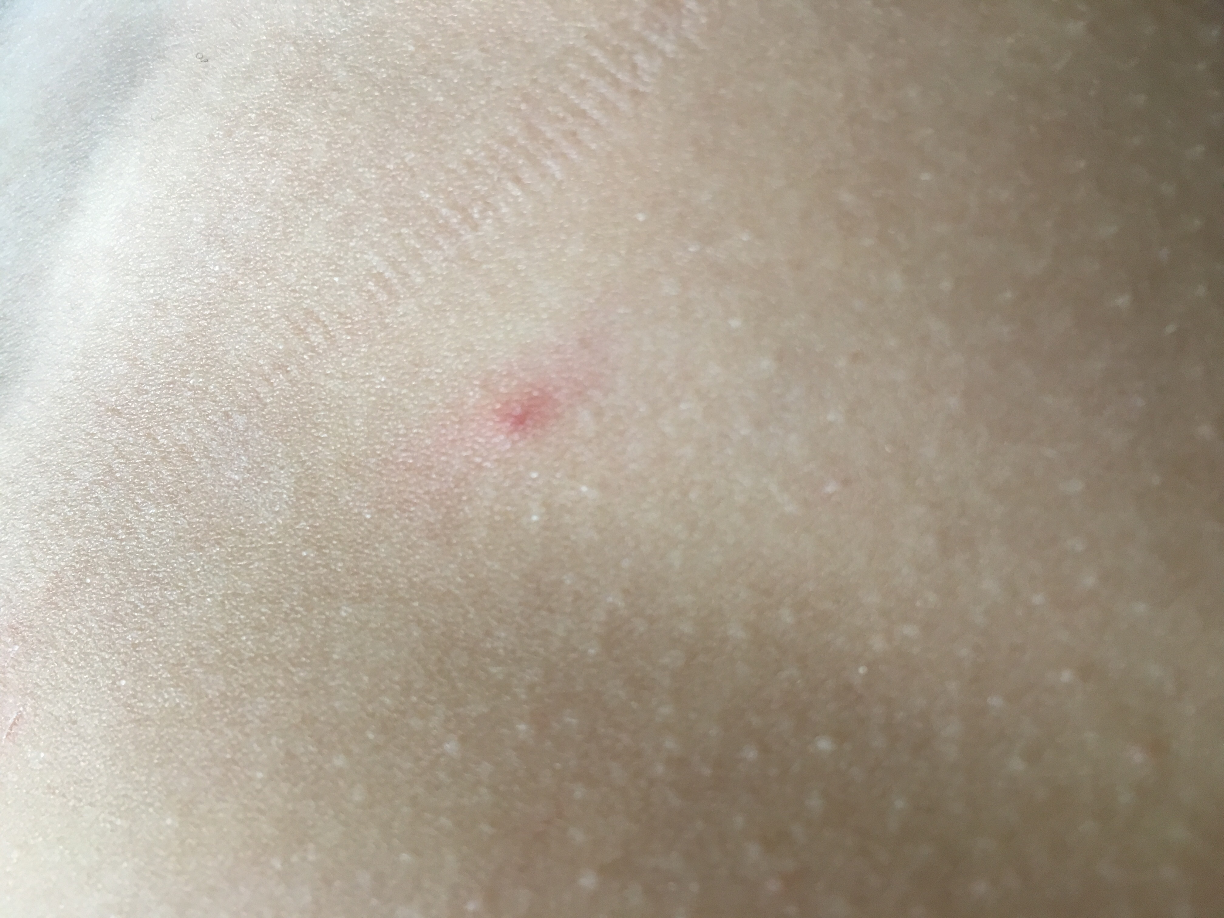 Rötung nach Zecke? (Gesundheit, Medizin, Zeckenbiss) Rötung nach Zecke? (Gesundheit, Medizin, Zeckenbiss)