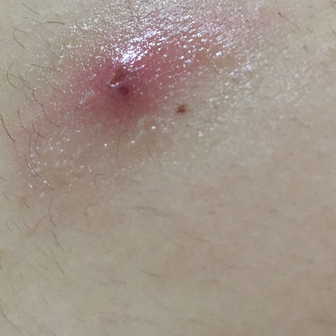 Rötung (und Pickel) tut höllisch weh? (Arzt, Schmerzen, Krankenhaus) pickel die weh tun