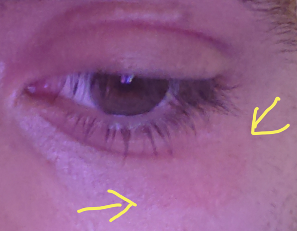 Rotung Unter Meinem Augenlid Geht Nicht Weg Gesundheit Und Medizin Beauty