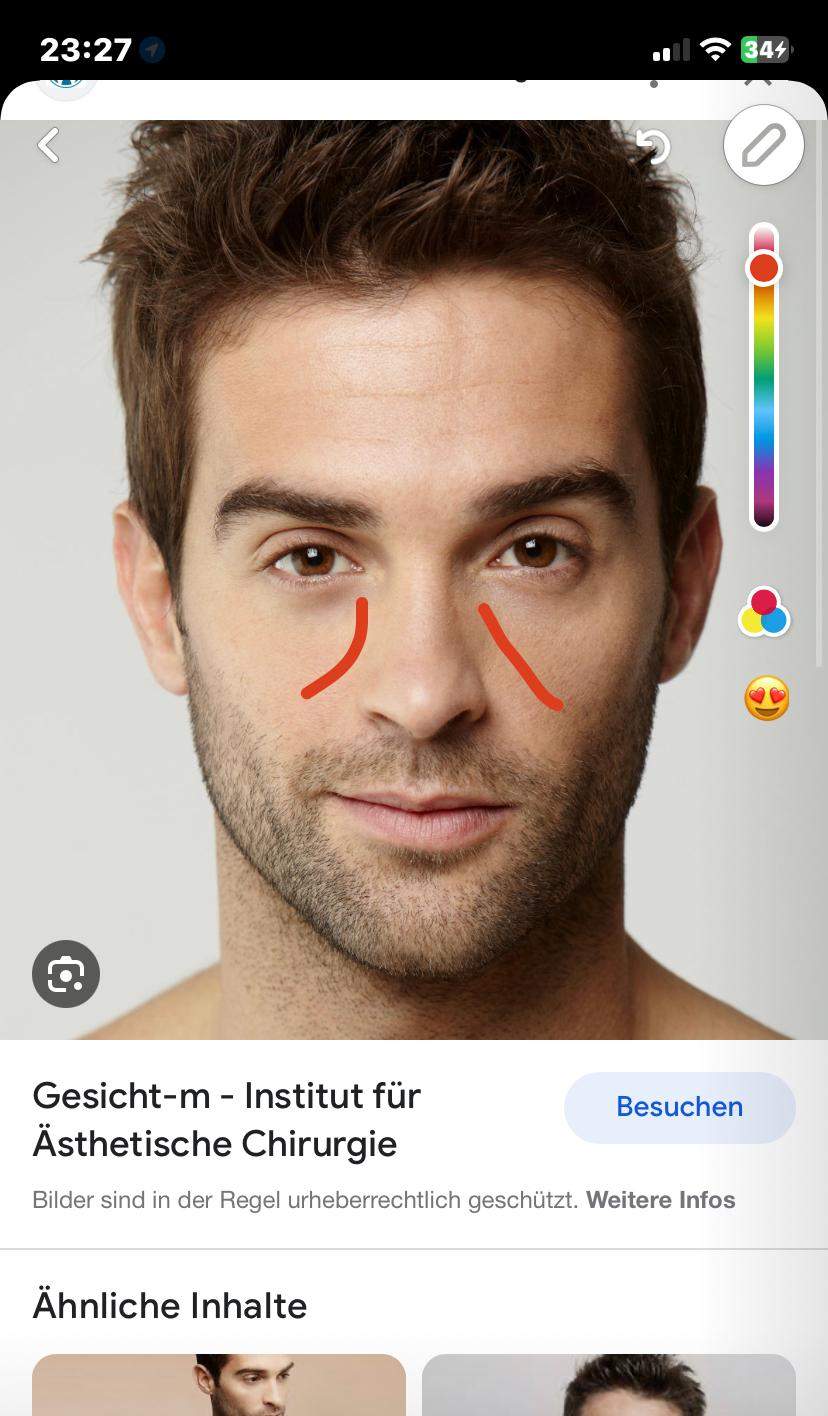 Rtungen Im Gesicht? (Haut, Pickel, Akne)