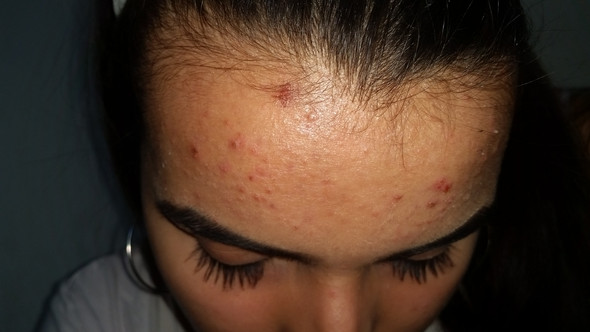 Rotungen Pickel Unreine Haut