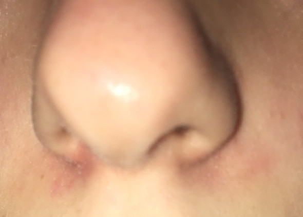 Rotungen Um Die Nase Die Uber Jahre Nicht Weggehen Haut Hautprobleme Rotungen Im Gesicht Rotungen Um Die Nase Die Uber Jahre Nicht Weggehen Haut Hautprobleme Rotungen Im Gesicht