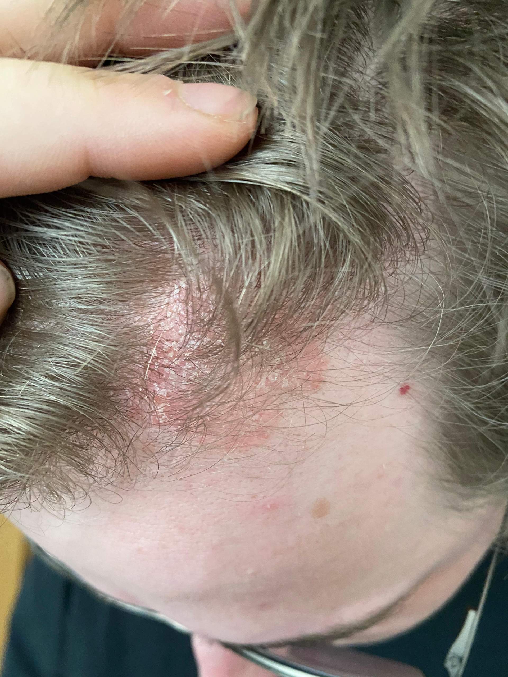 Rötungen und Schuppen auf der Kopfhaut? (Haare)