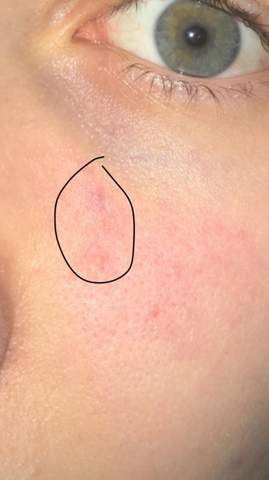 Rosa Flecken Im Gesicht Haut Pickel Rosa Flecken Im Gesicht Haut Pickel