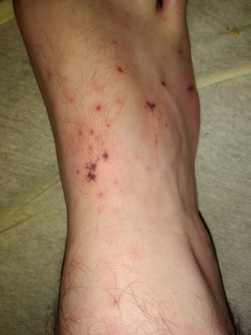 Rot Schwarze Flecken Am Fuss Dringend Hilfe Medizin Schmerzen Haut