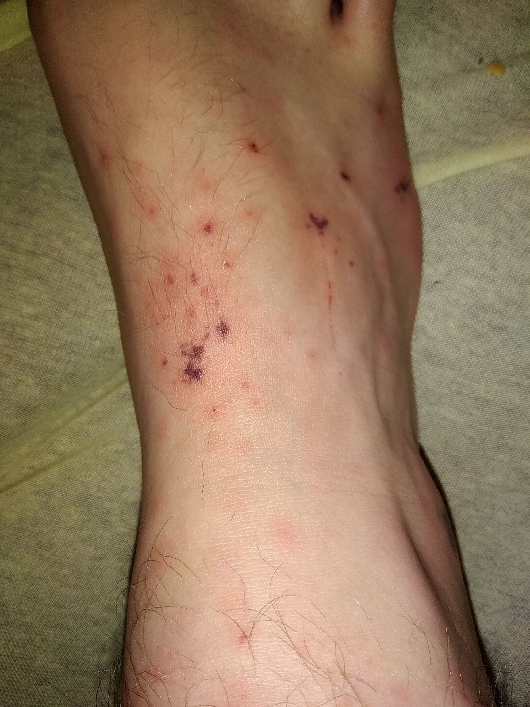Rot Schwarze Flecken am Fuß dringend hilfe? (Medizin, Schmerzen, Haut)