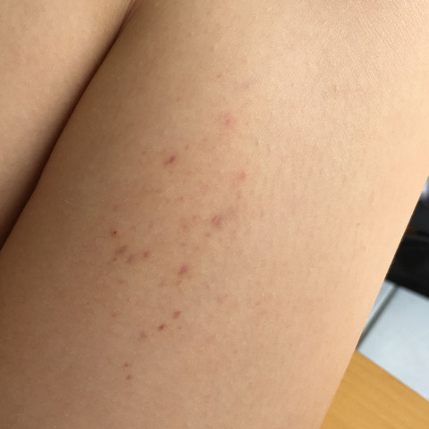 Da diese rot blauen Punkte - (Haut, Hautarzt, Hautpunkte)