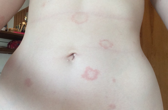 Rot Umkreiste Raue Stelle Gesundheit Und Medizin Haut Ausschlag Rot Umkreiste Raue Stelle Gesundheit Und Medizin Haut Ausschlag