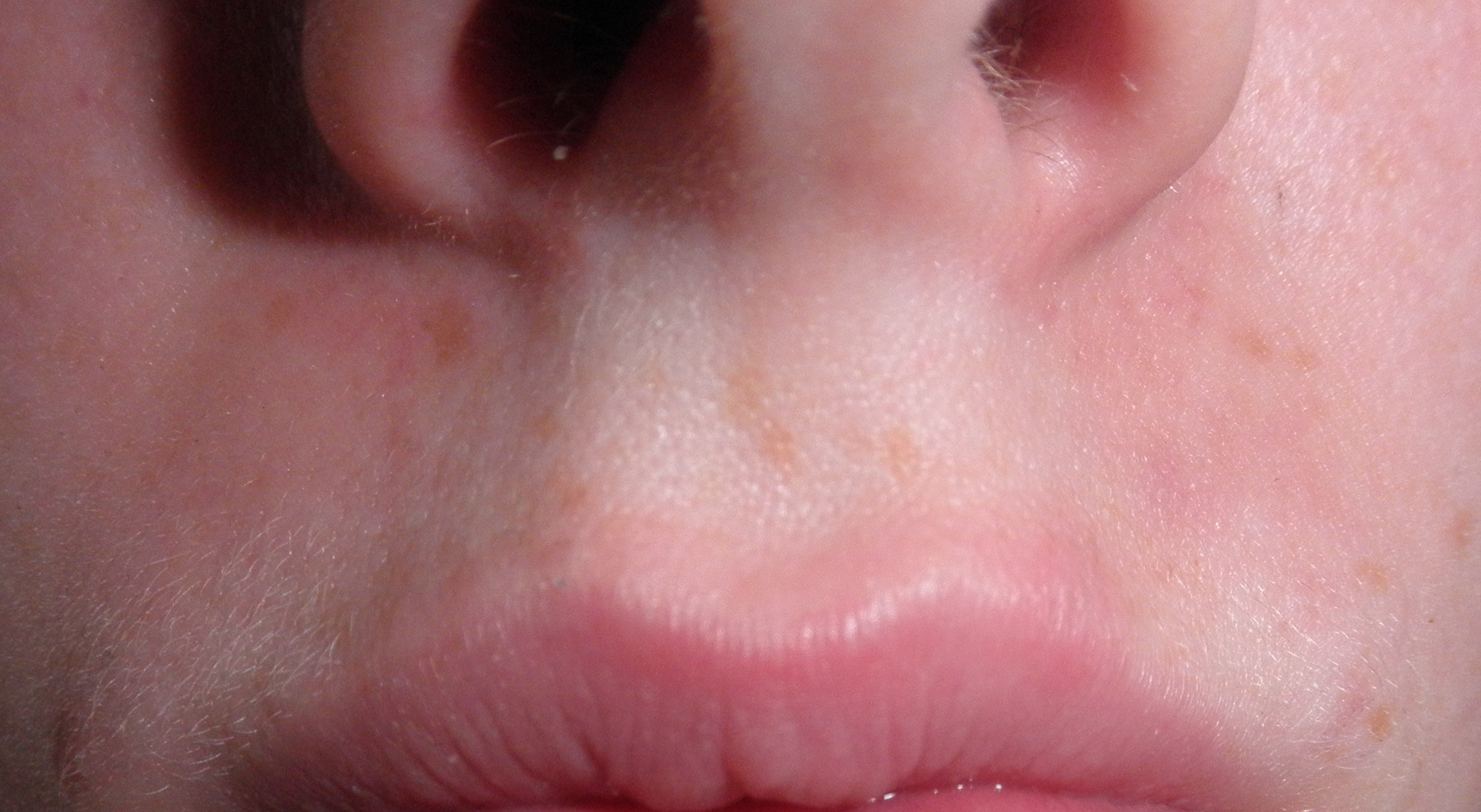 Download Pickel Unter Der Haut Geht Nicht Weg PNG