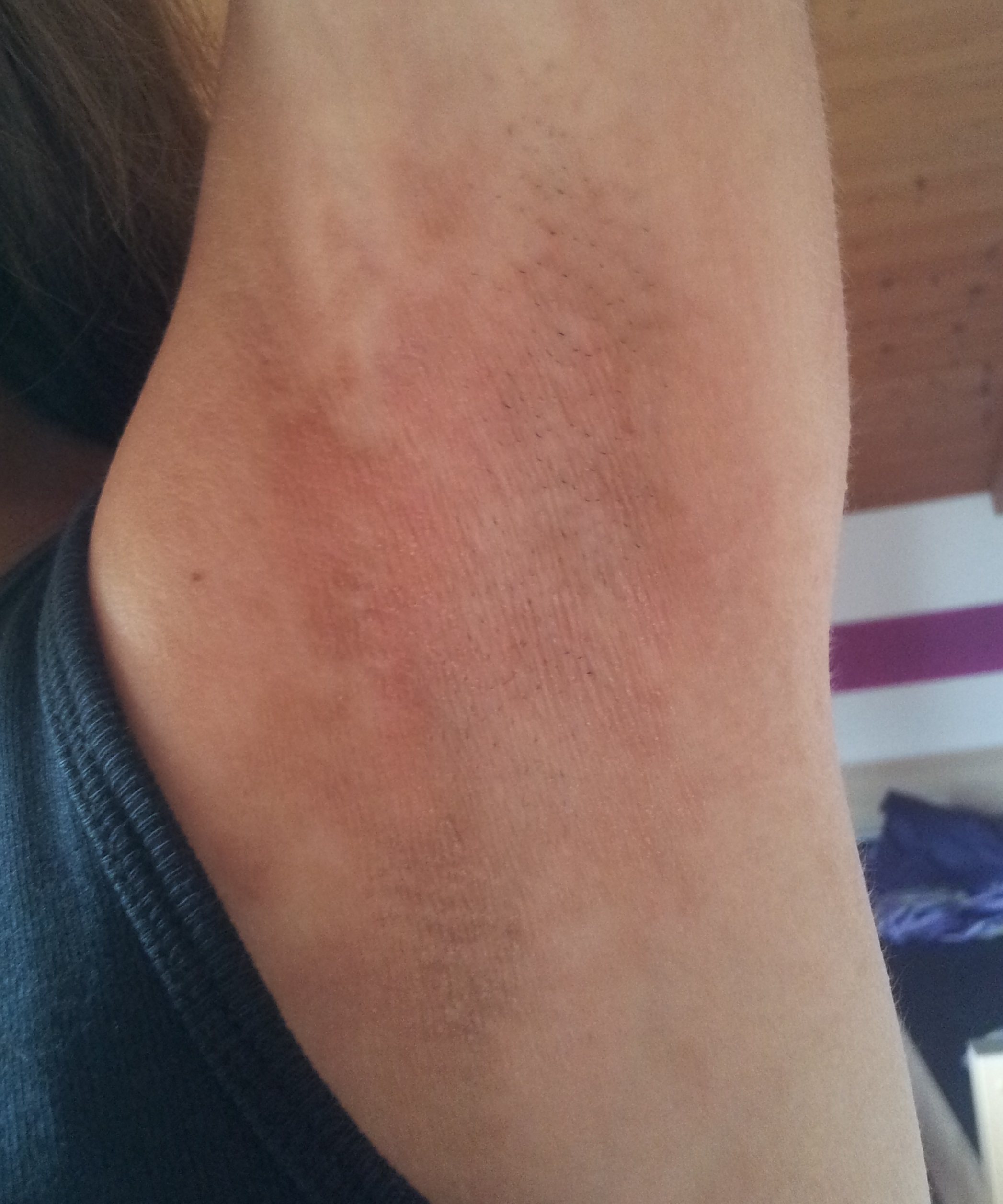 rote achseln..? (Haut)