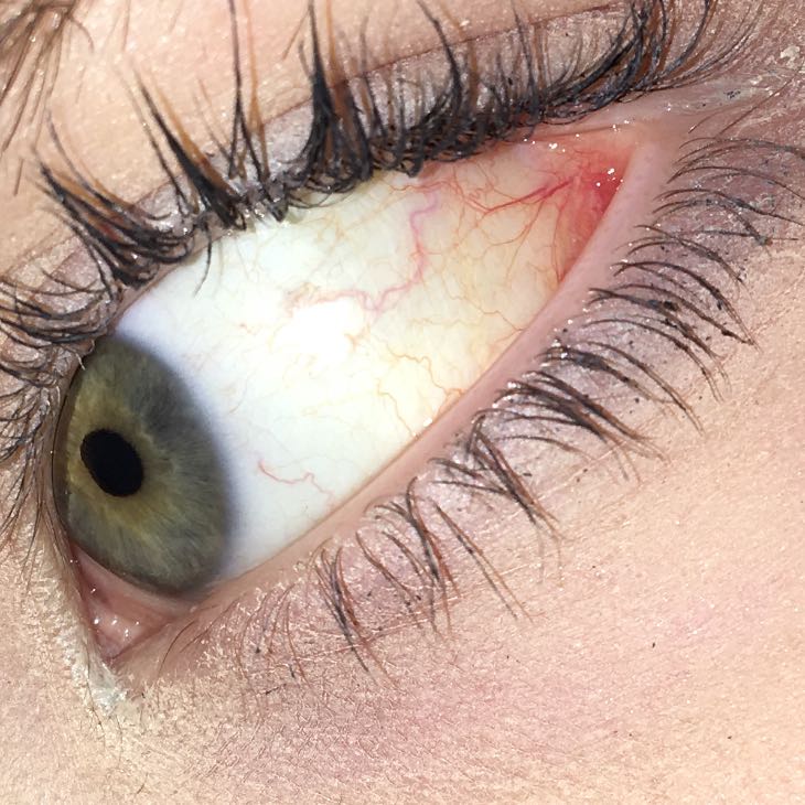 Rote Adern Im Auge - Captions Imajinative