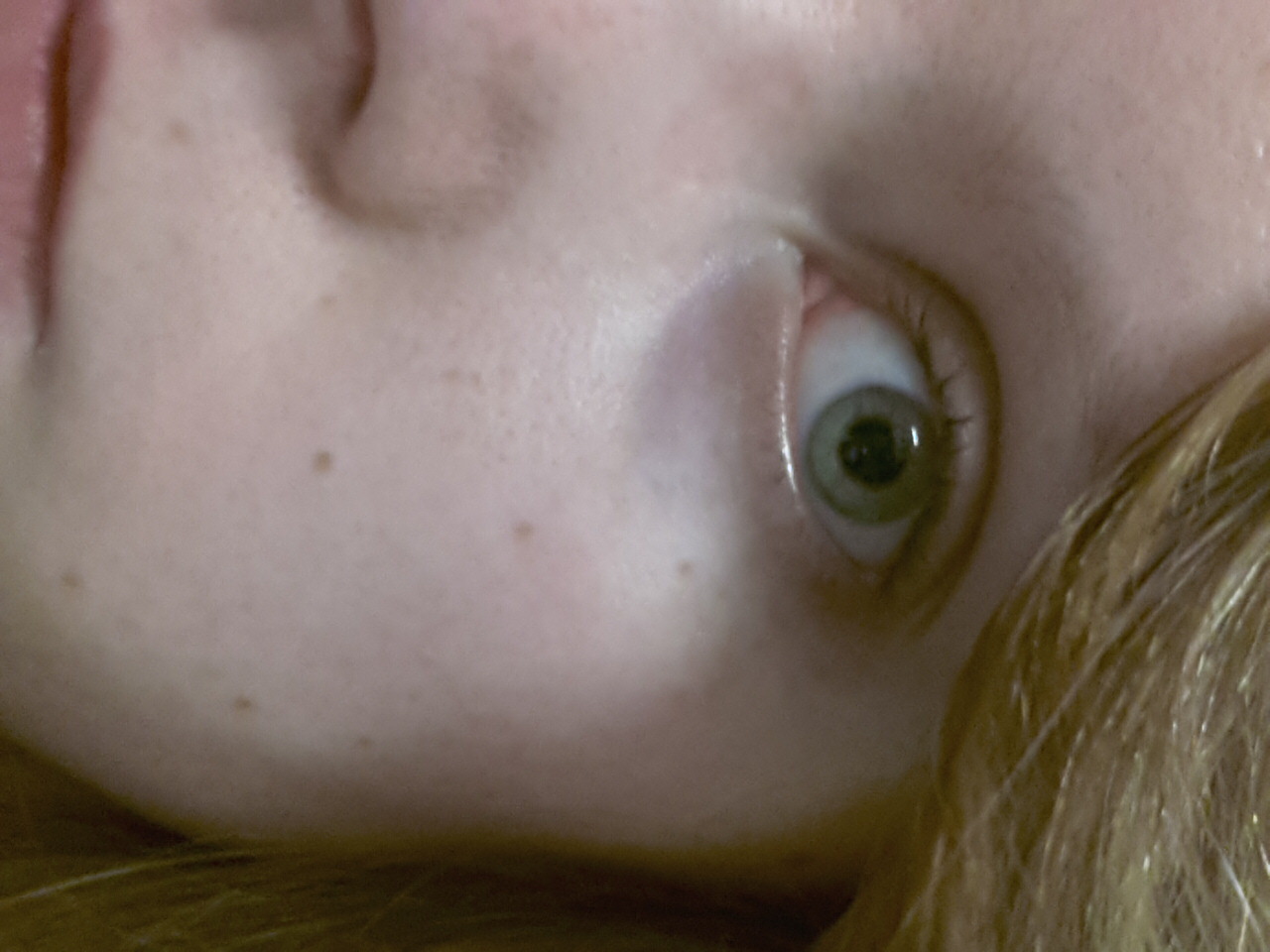 Rote Äderchen im Auge, trockenes/brennendes Auge. Wie bekomme ich die Äderchen wieder weg (trage