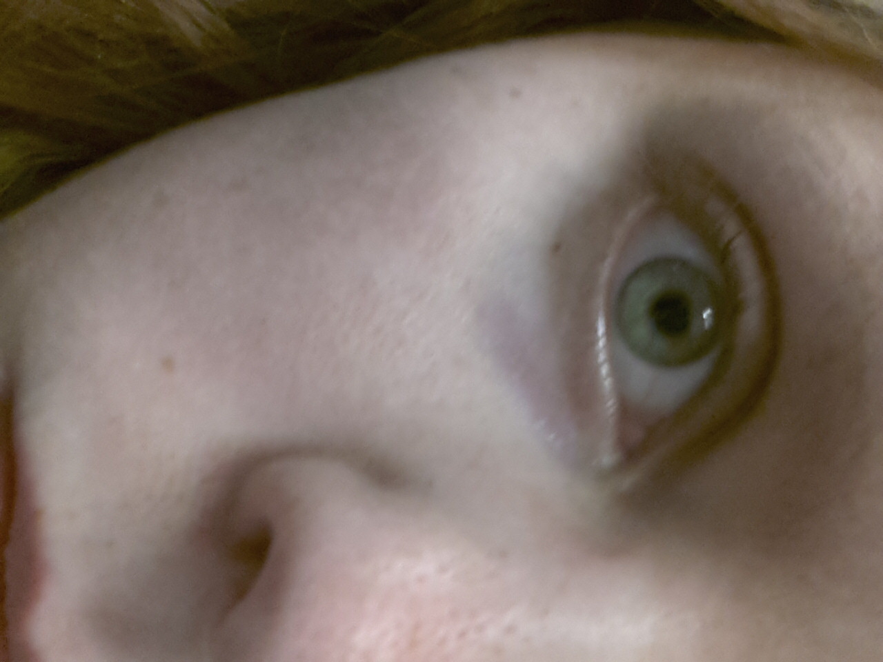 Rote Äderchen im Auge, trockenes/brennendes Auge. Wie bekomme ich die Äderchen wieder weg (trage
