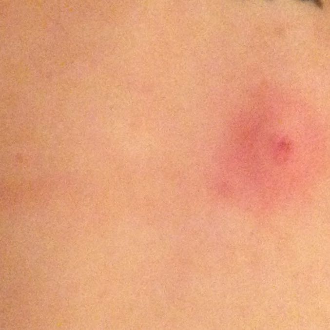 Rote beule am Rücken? (Pickel) pickel auf dem rücken frau