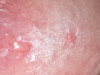 Rote Blaschen Auf Eichel Nach Oralsex Penis Pickel Geschlechtsverkehr Rote Blaschen Auf Eichel Nach Oralsex Penis Pickel Geschlechtsverkehr