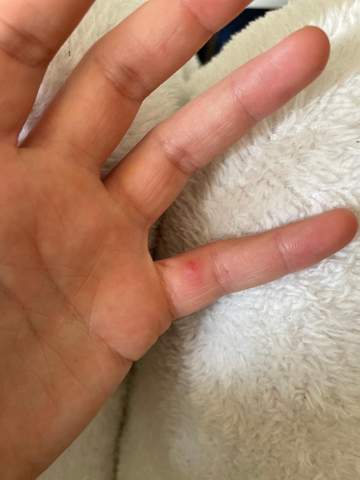 Rote Blasen An Den Fingern Haut Rote Blasen An Den Fingern Haut