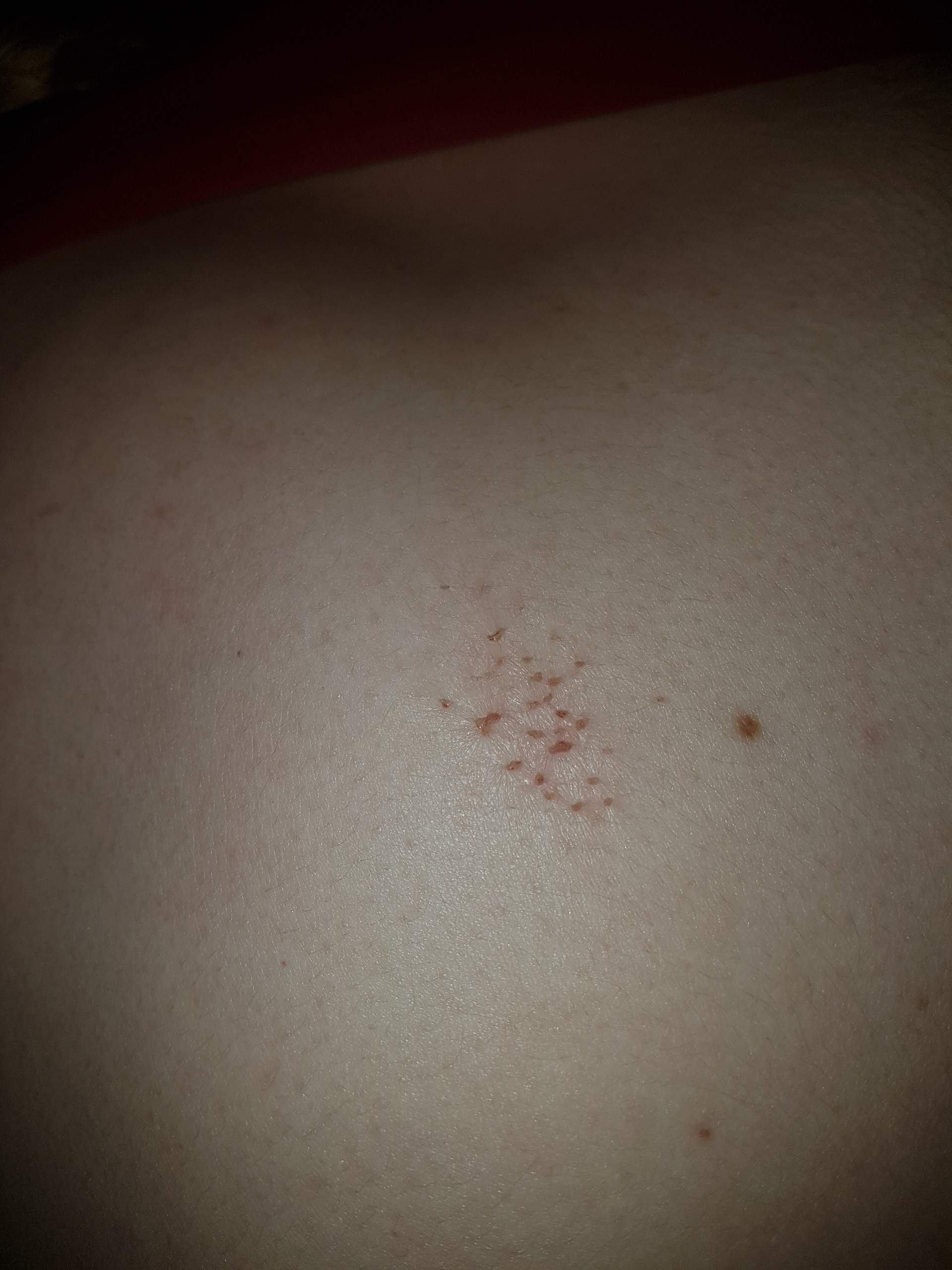 Rote braune krustige Punkte am Rücken? (Gesundheit und Medizin ...