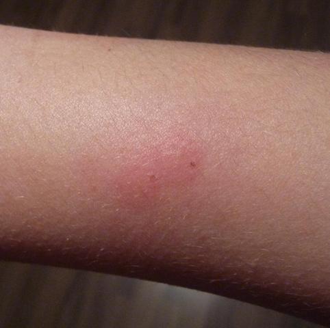 Rote Dicke Stiche Von Welchem Tier Hilfe Korper Stich Bisse