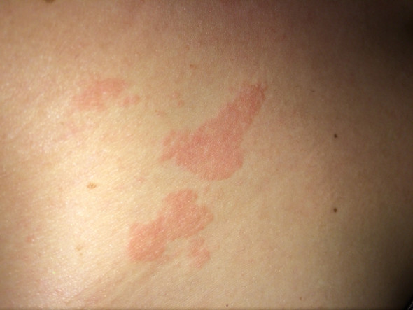Es sind nur diese 3 Flecken, mehr nicht - (Gesundheit, Medizin, Körper)