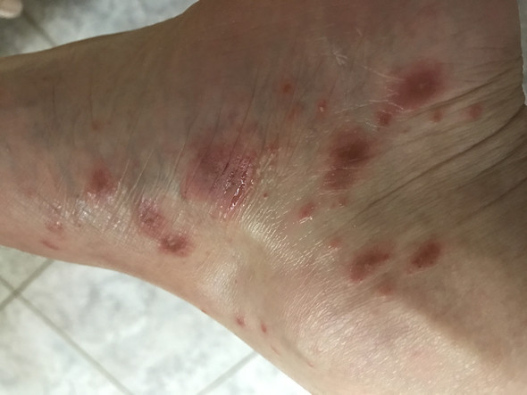 Rote Flecken (Fuß) - (Medizin, Haut, Füße)