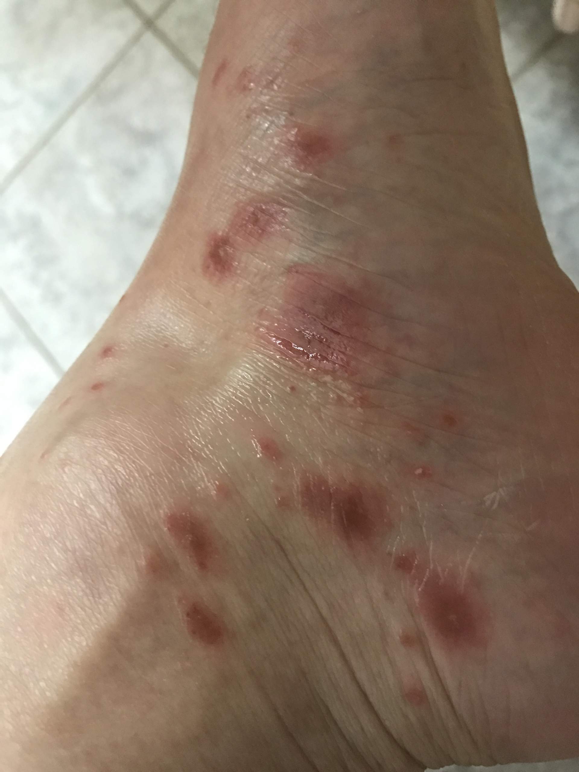 Rote Fleck was ist das? (Medizin, Haut, Füße) Rote Fleck was ist das? (Medizin, Haut, Füße)