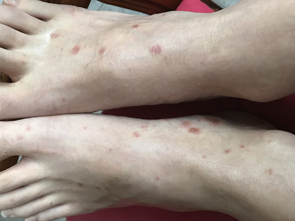 Rote Flecken (Füße) - (Medizin, Haut, Füße)