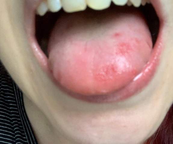 Rote Flecke Zunge Gesundheit Und Medizin Gesundheit Rote Flecke Zunge Gesundheit Und Medizin Gesundheit