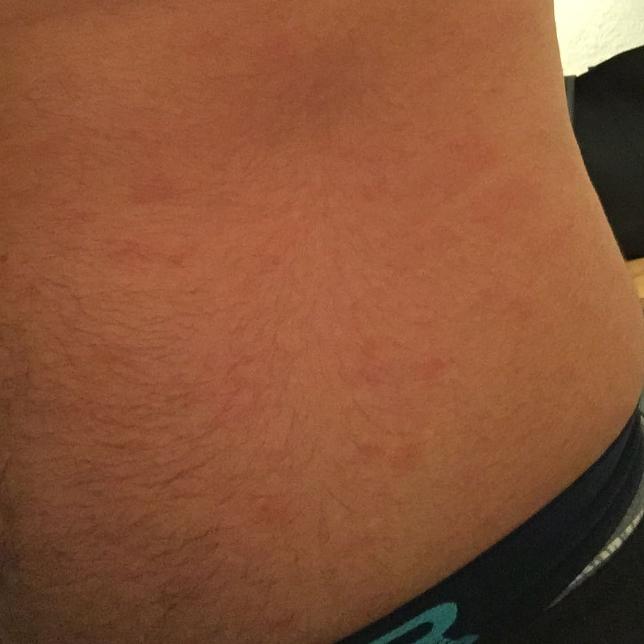 Rote Flecke am Bauch? (fett, Zunahme, rote flecken)