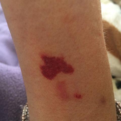 Rote Flecken Altersflecken Hautkrebs Haut Rote Flecken Altersflecken Hautkrebs Haut