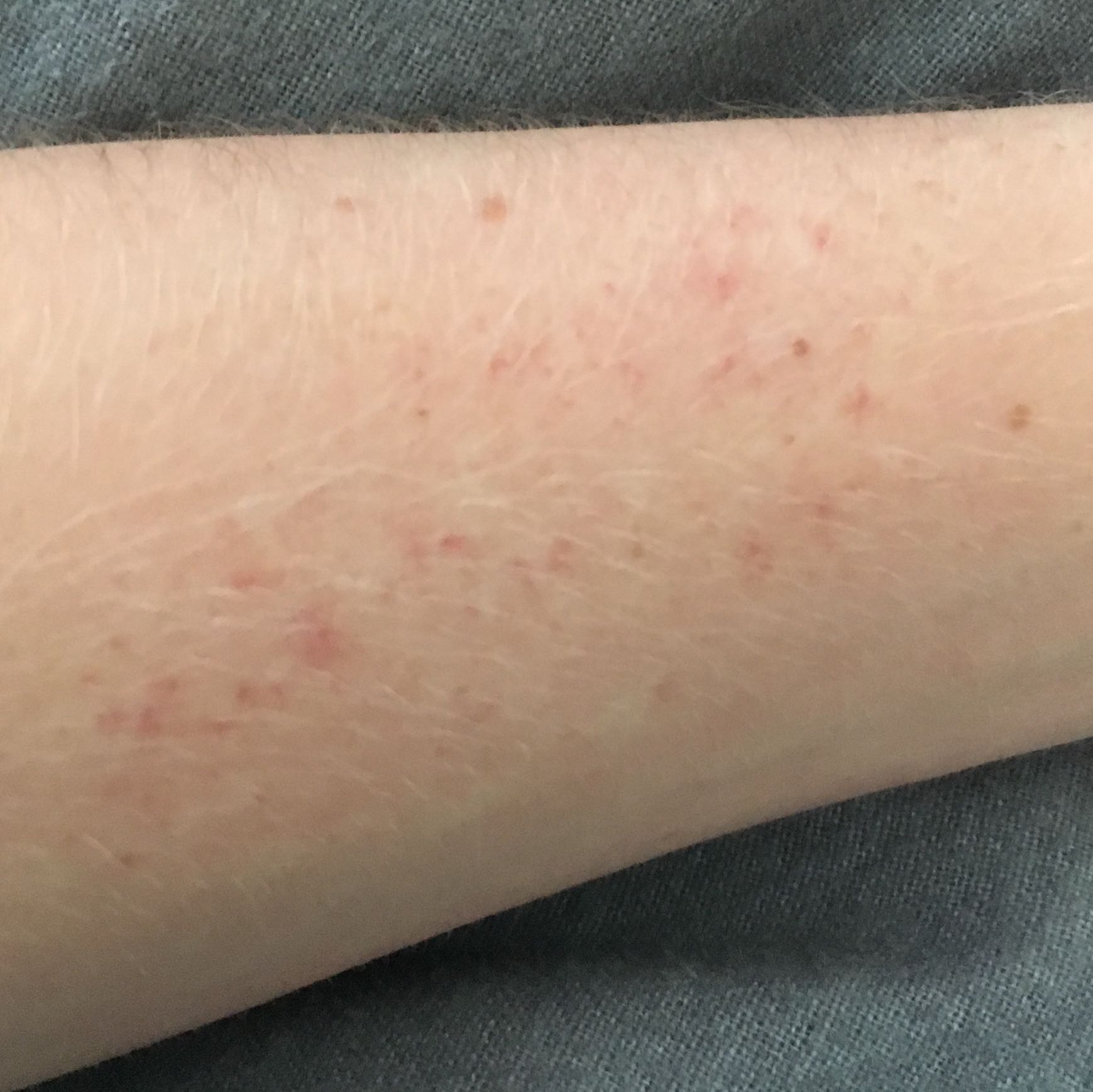 Rote Flecken am Arm mit Weißen Punkten? (Gesundheit und Medizin, Arzt