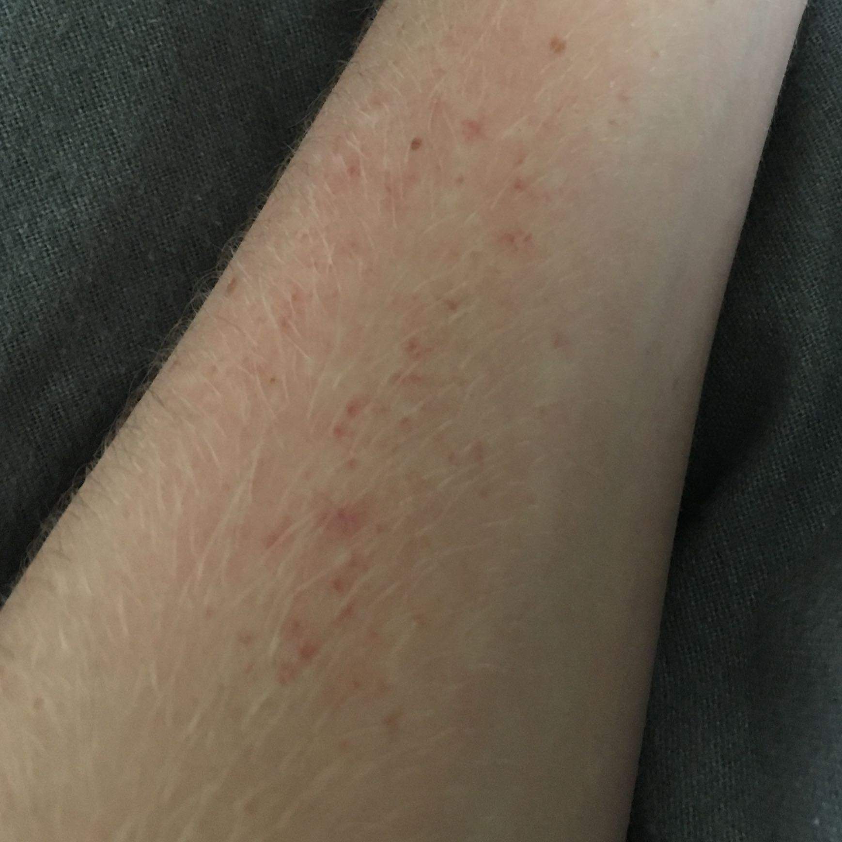 Rote Flecken am Arm mit Weißen Punkten? (Gesundheit und Medizin, Arzt