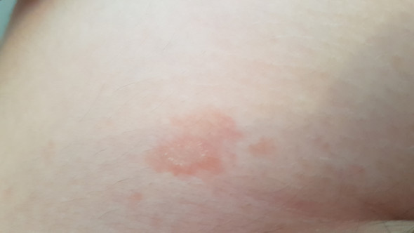 Rote Flecken Am Bauch Die Nicht Brennen Oder Jucken Sondern Einfach Nur Da Sind Was Ist Das Krankheit Haut Allergie Rote Flecken Am Bauch Die Nicht Brennen Oder Jucken Sondern Einfach Nur Da Sind Was Ist Das Krankheit Haut Allergie