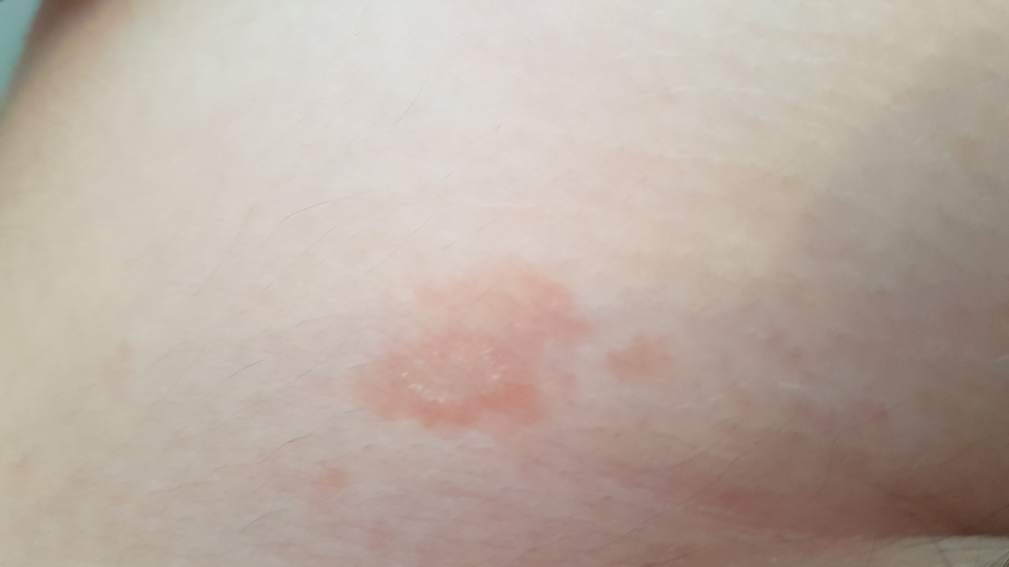 Rote flecken am bauch die nicht brennen oder jucken sondern einfach nur Rote flecken am bauch die nicht brennen oder jucken sondern einfach nur