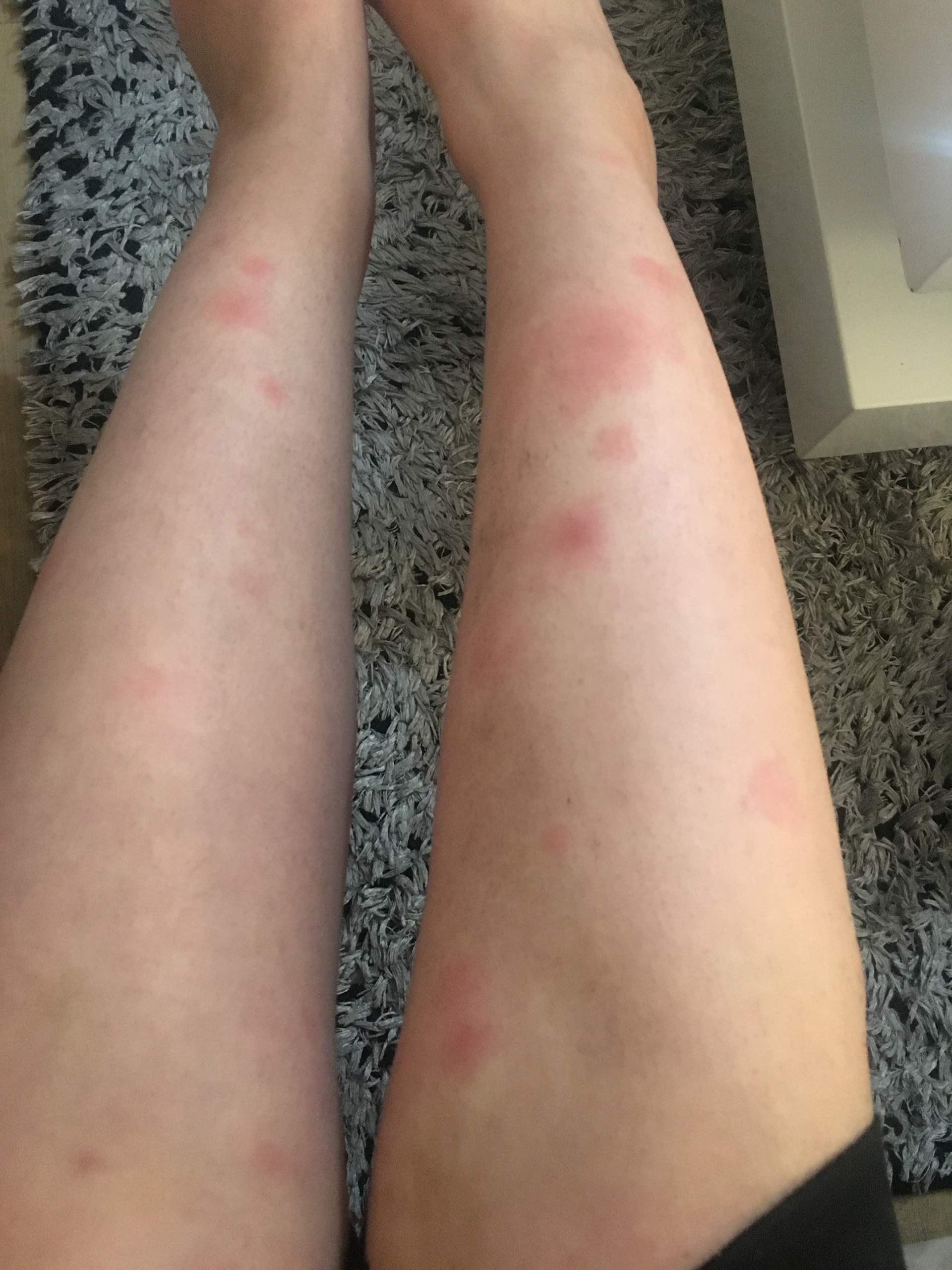 Rote Flecken am Bein und die Ärzte wissen nicht was es ist? (Schmerzen, Haut, Rötung)