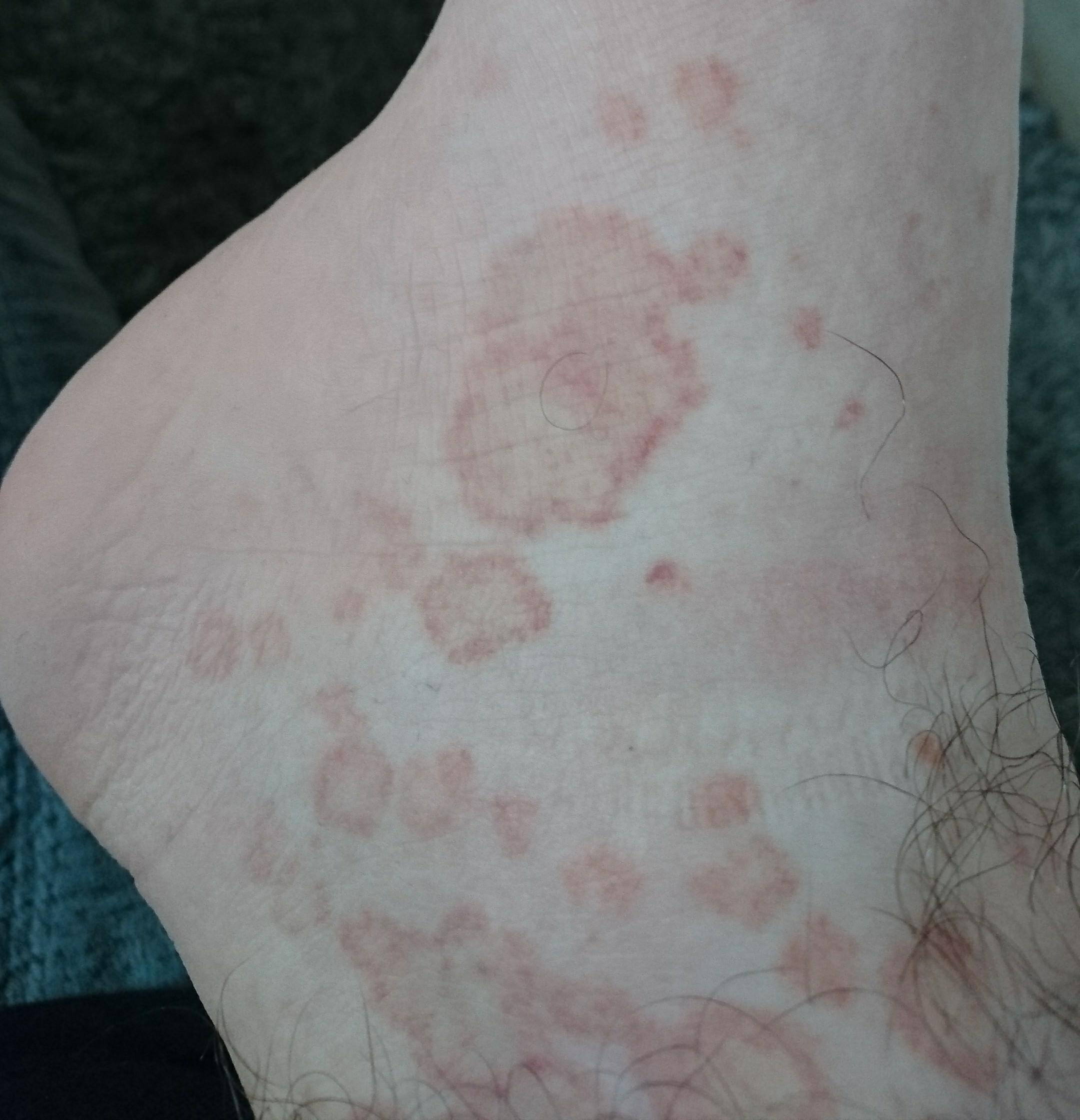 Rote Flecken am Fuß was kann dass sein? (Gesundheit und Medizin, Haut)