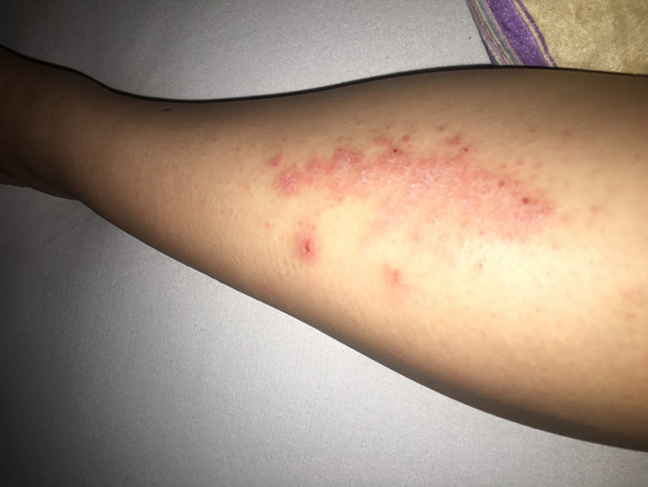 - (Krankheit, Haut, Allergie)