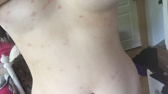 Rote Flecken Am Ganzen Oberkorper Hautausschlag Rote Flecken Am Ganzen Oberkorper Hautausschlag