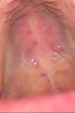 Rote Flecken Am Gaumen Was Kann Das Sein Gesundheit Rote Flecken Am Gaumen Was Kann Das Sein Gesundheit