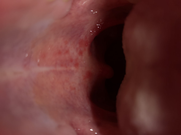 Rote Flecken Am Gaumen Was Is Das Gesundheit Und Medizin Krankheit Rote Flecken Am Gaumen Was Is Das Gesundheit Und Medizin Krankheit