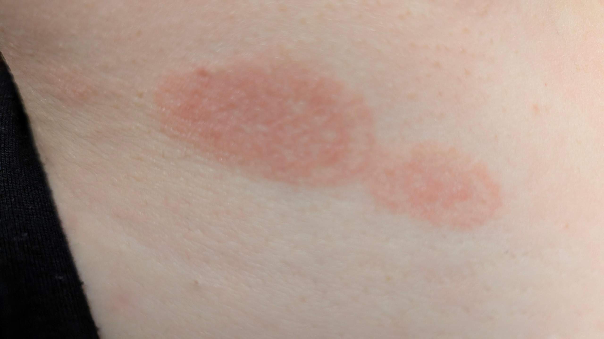 Rote Flecken am Hals? (Haut, Entzündung, Allergie)