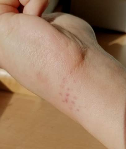 Rote Flecken Am Handgelenk Deutung Auf Was Ernstes Gesundheit Haut Vorbeugung Rote Flecken Am Handgelenk Deutung Auf Was Ernstes Gesundheit Haut Vorbeugung