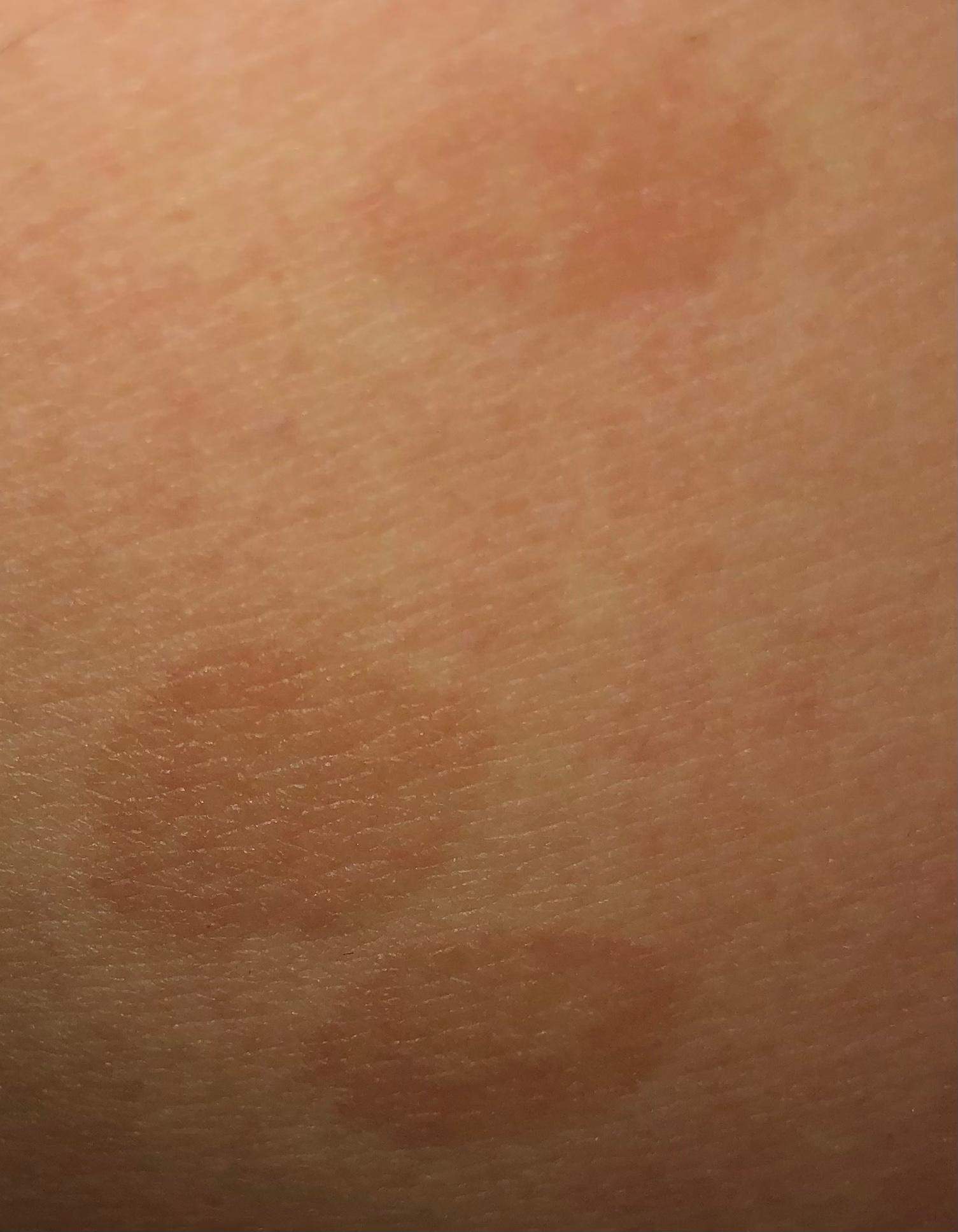 Rote Flecken am Körper? (Gesundheit und Medizin, Haut)
