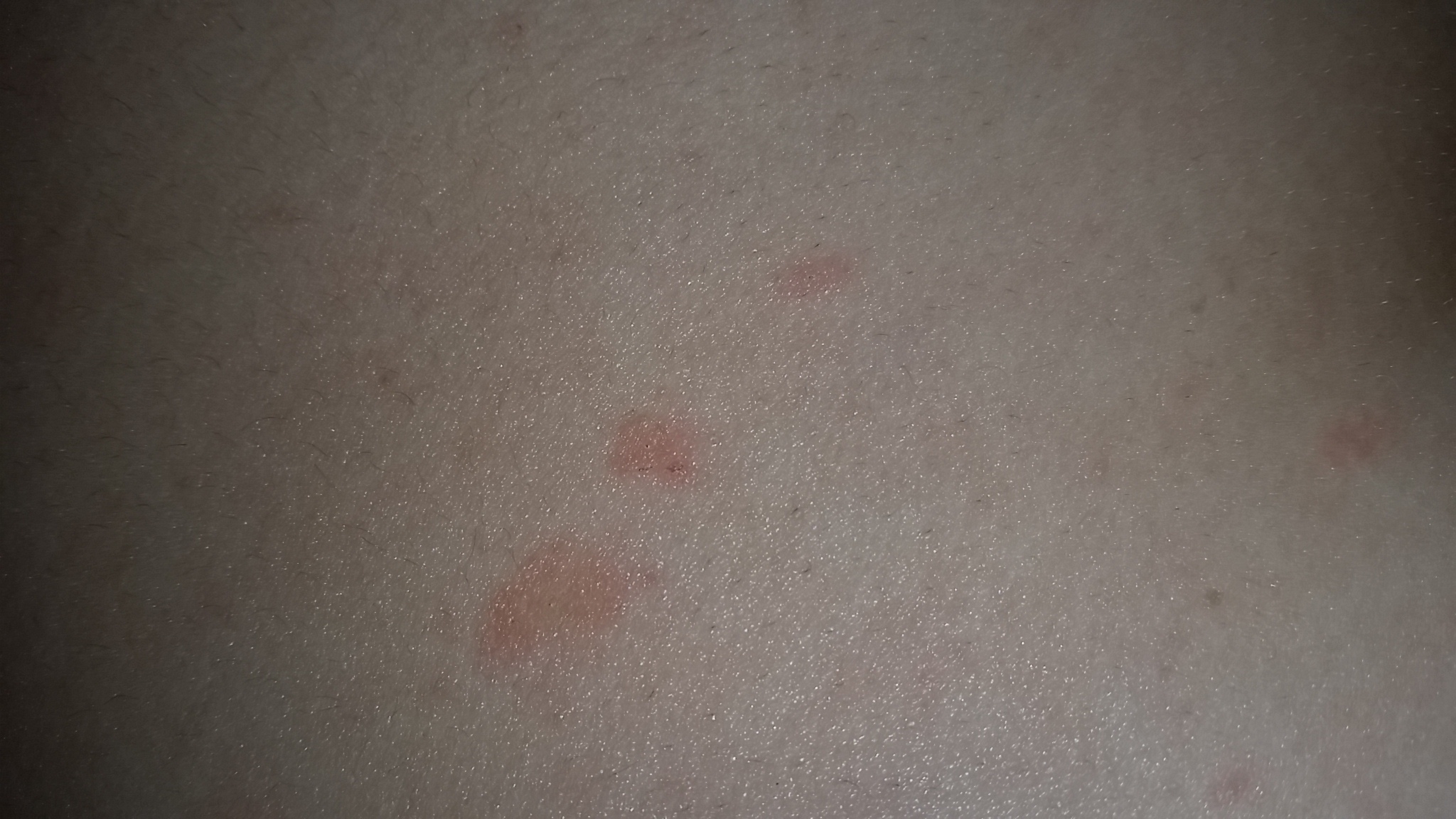 Rote Flecken am Körper (BAUCH UND BEINE) (Medizin, Arzt, Hautarzt)