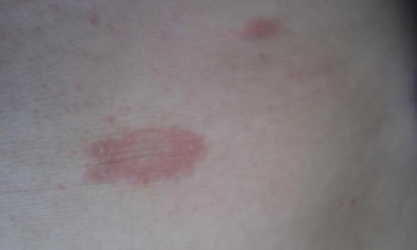 Rote Flecken Am Korper Was Ist Das Gesundheit Medizin Krankheit Rote Flecken Am Korper Was Ist Das Gesundheit Medizin Krankheit