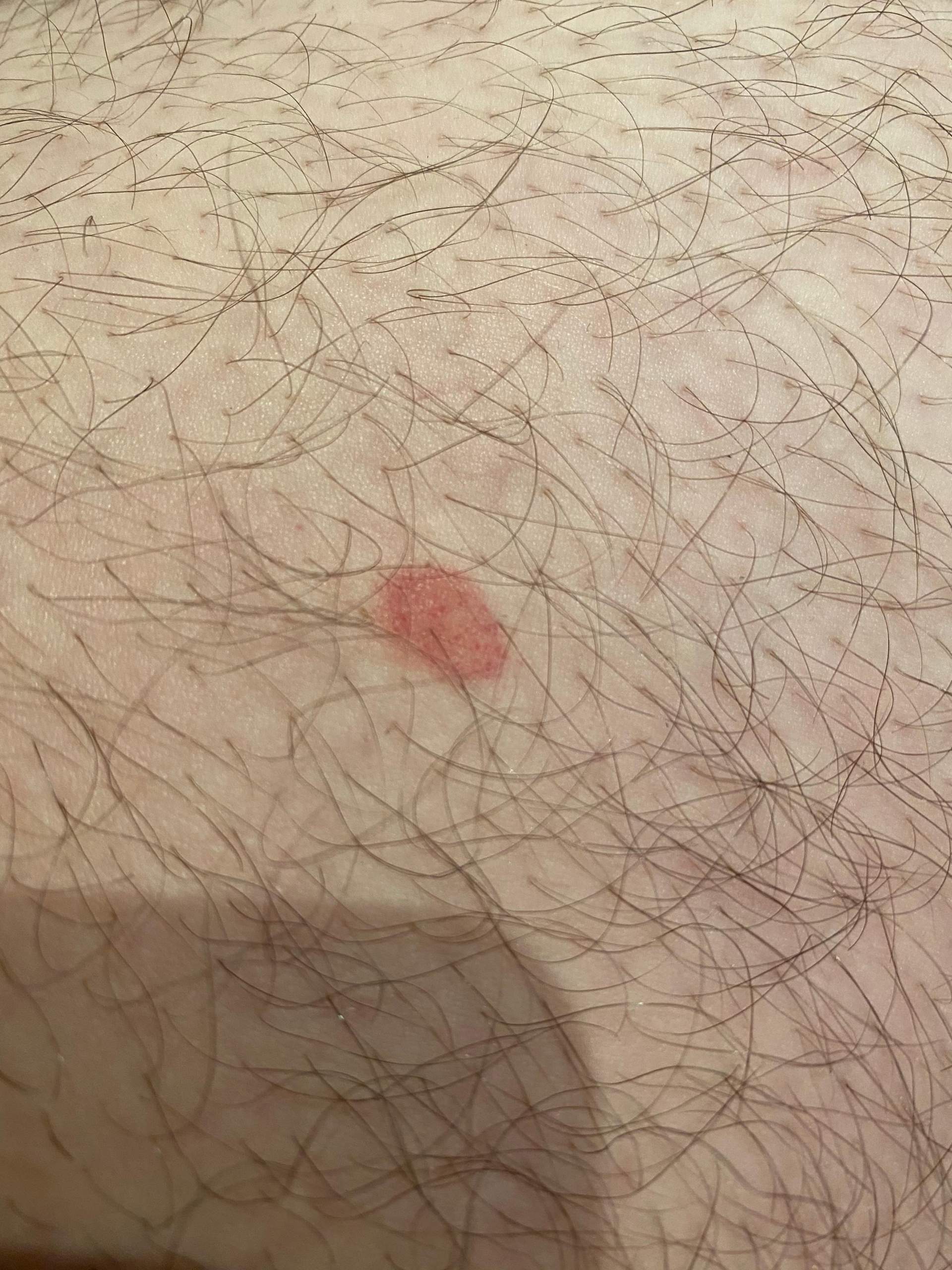 Rote Flecken am Oberschenkel ist das was gefährliches ? (Haut)