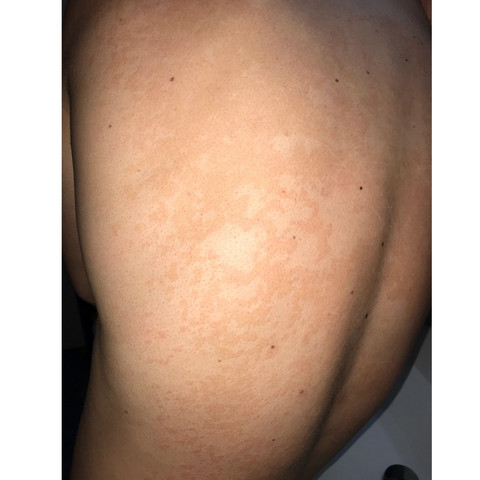 Rote Flecken Am Rucken Die Jucken Gesundheit Und Medizin Arzt Haut