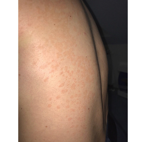 Rote Flecken Am Rucken Die Jucken Gesundheit Und Medizin Arzt Haut Rote Flecken Am Rucken Die Jucken Gesundheit Und Medizin Arzt Haut