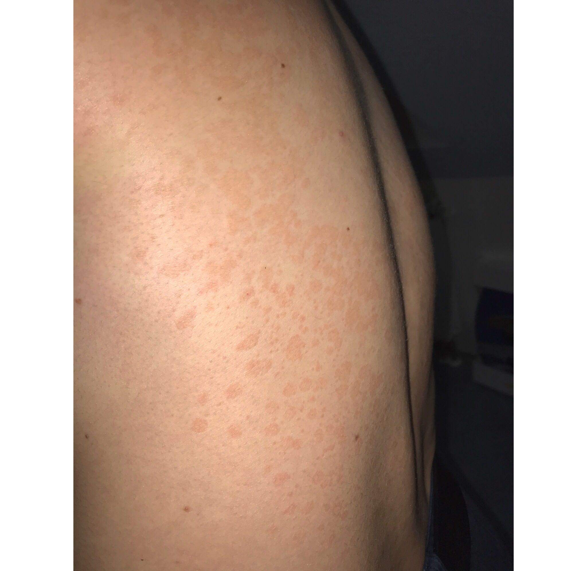 Rote Flecken am Rücken die jucken? (Gesundheit und Medizin, Arzt, Haut)