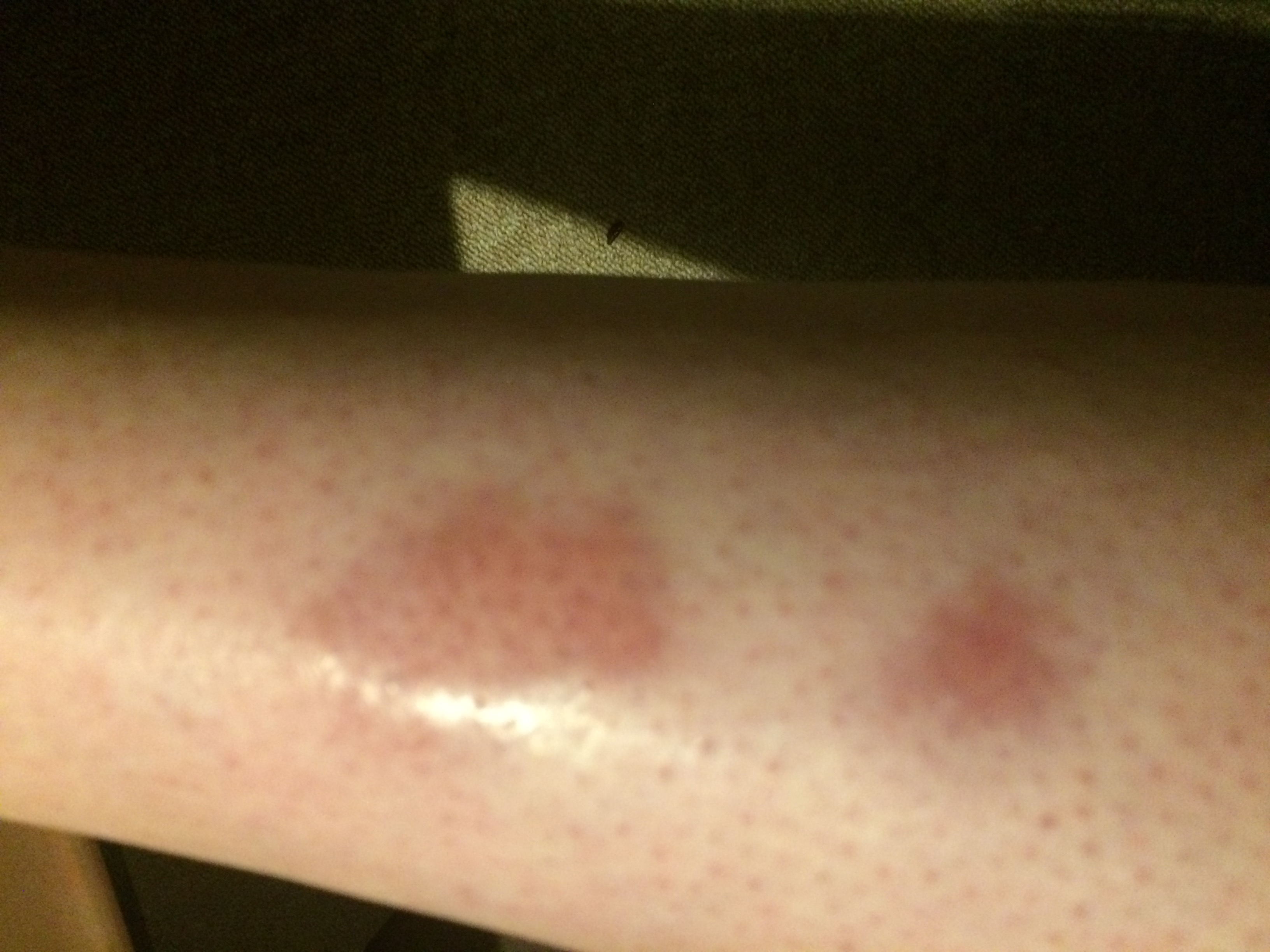 Rote Flecken am Schienbein - was ist das? (Hautarzt, Dermatologie)